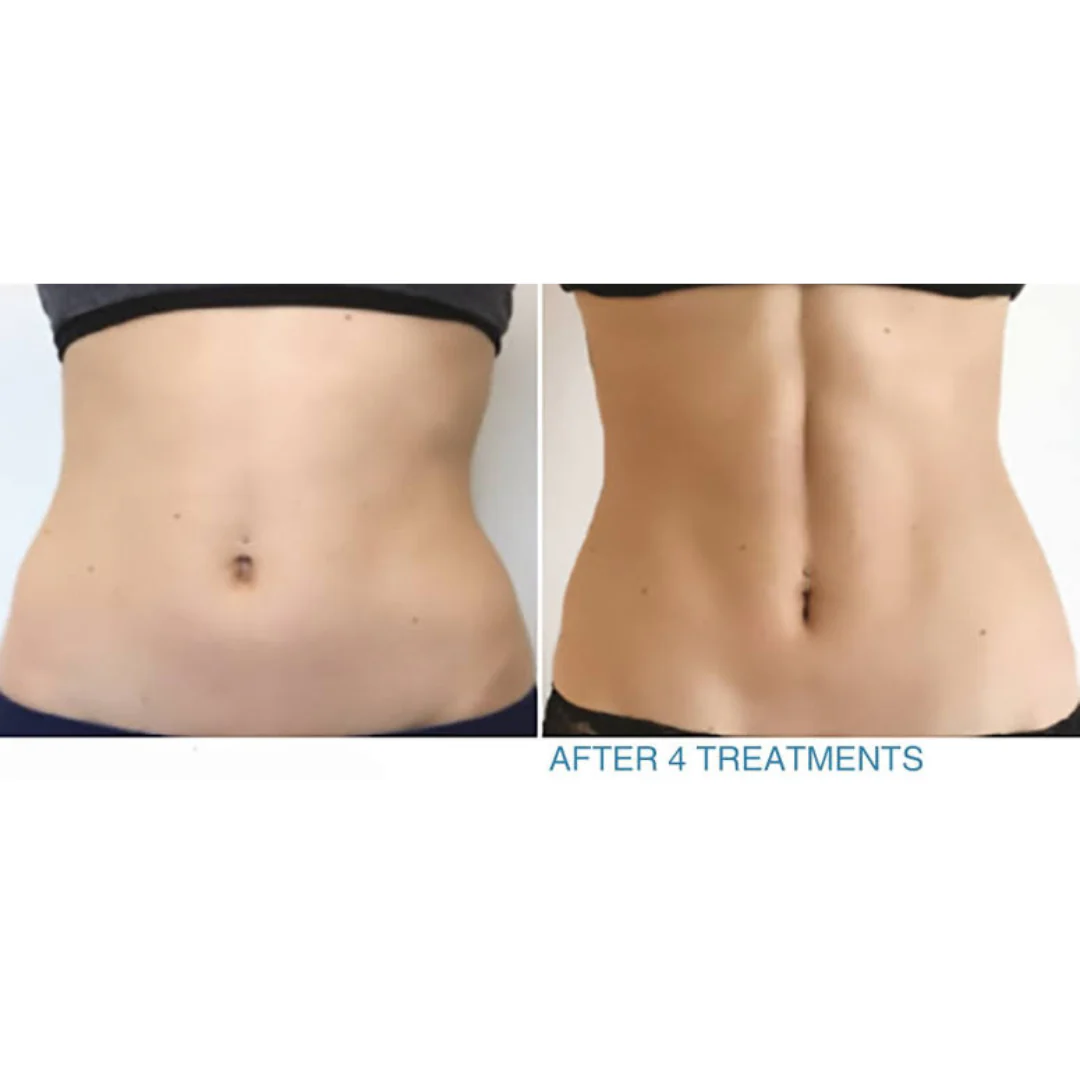 Before and after comparison of abdominal area after four treatments, showing a visible improvement in body contour.